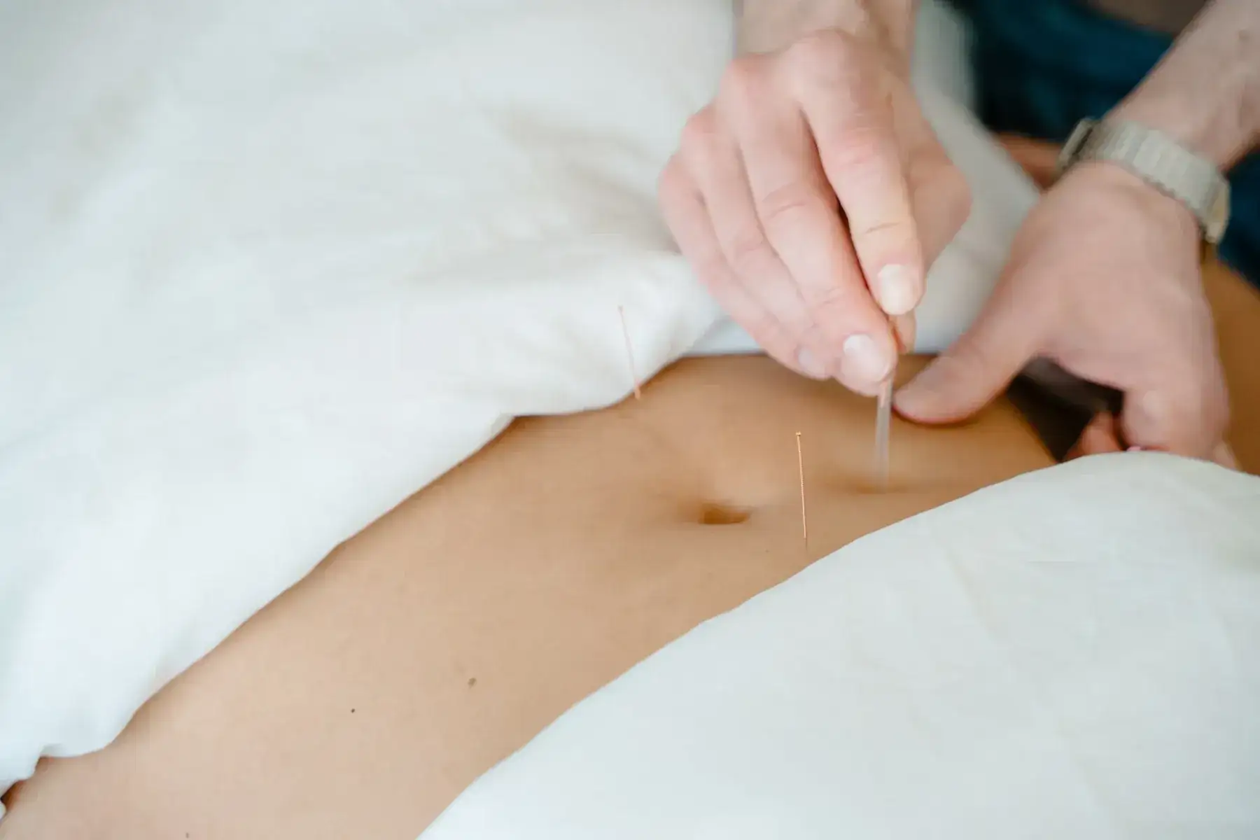 An acupuncturist placing a fine needle in the abdomen of a client resting under white linens