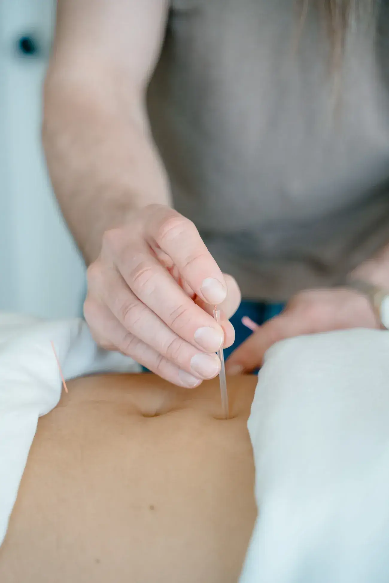An acupuncture needle being placed beside the navel on a client's abdomen at Renu in Calgary, the arms left untouched