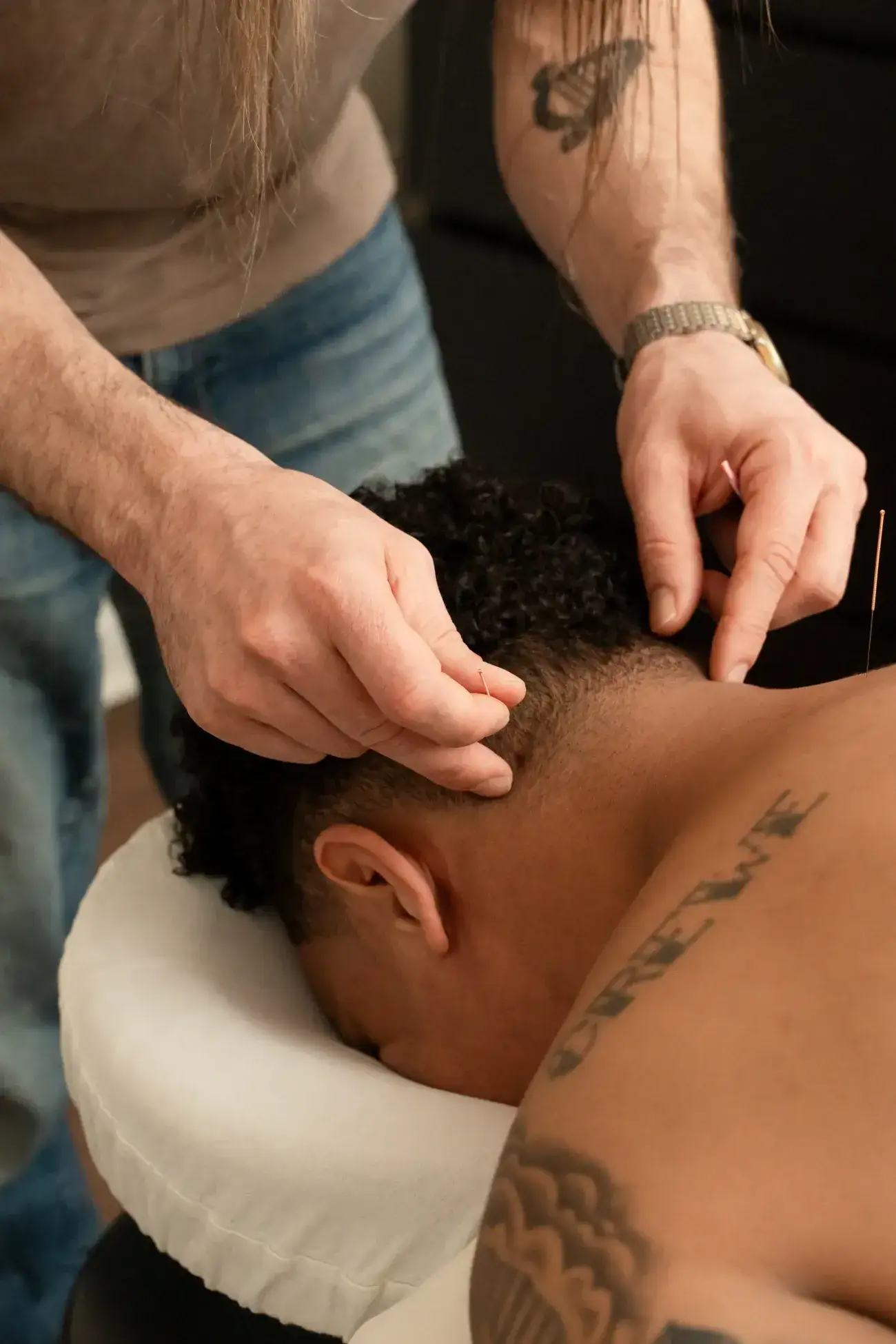 An acupuncturist placing a fine needle near the hairline at the back of the head of a client lying face down