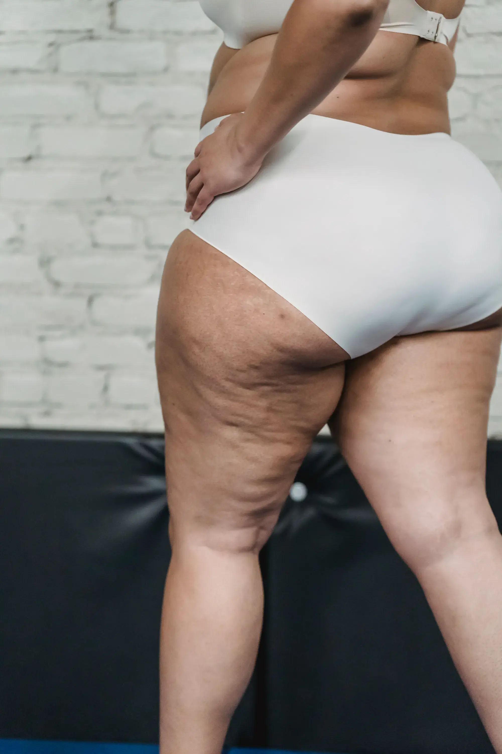 A woman standing in white underwear, showing the dimpled, column-like legs typical of lipedema